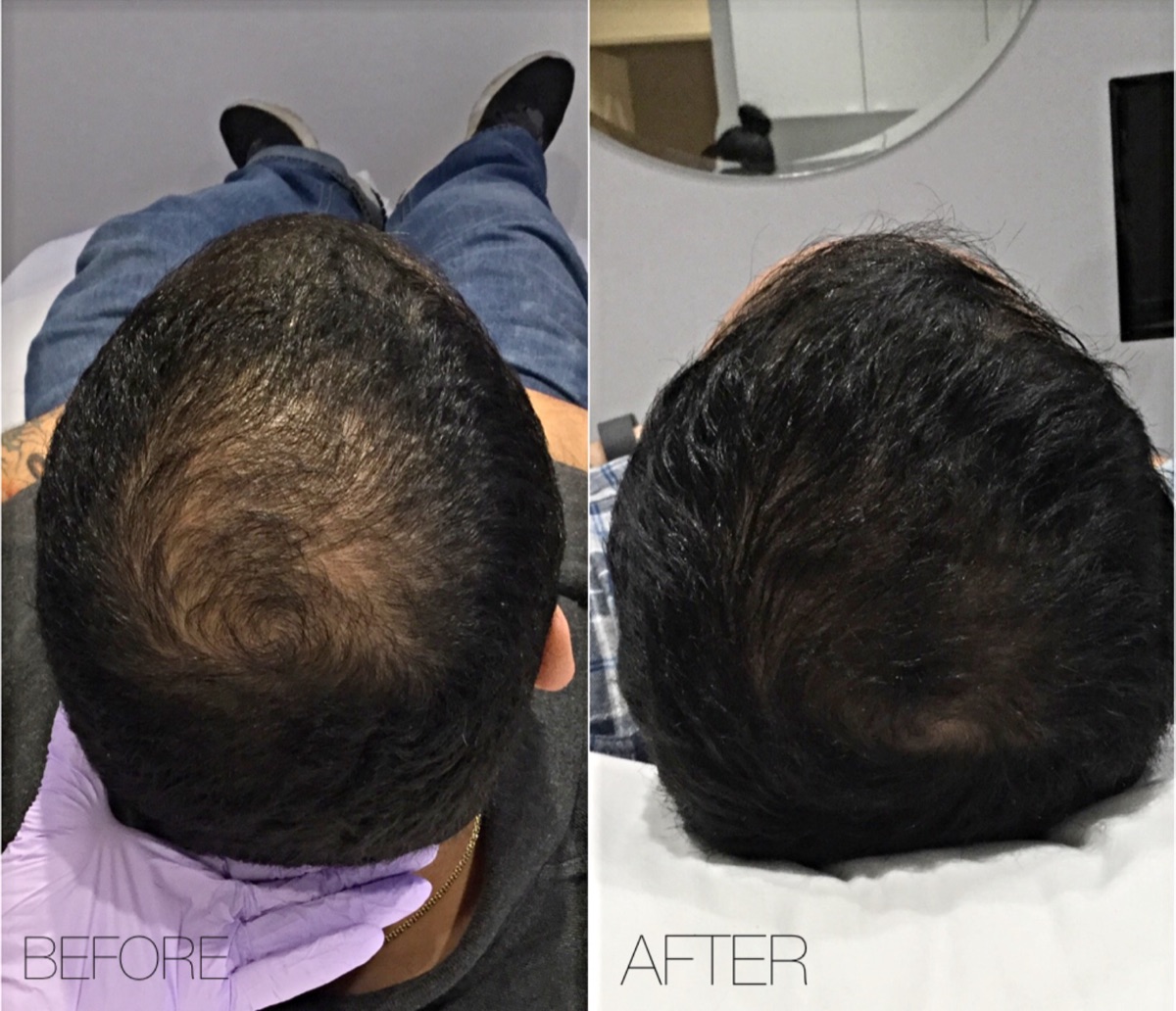 Men's hair restoration before and after results